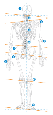 Beinlängendifferenz
